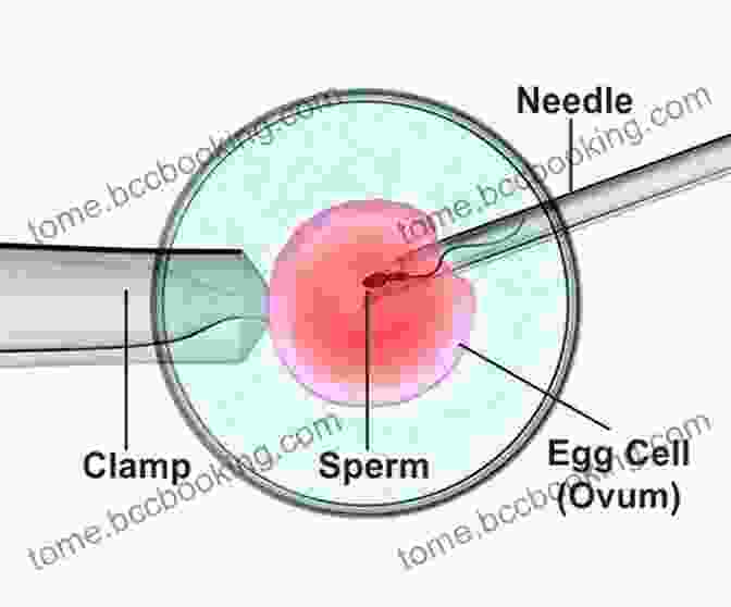 Intracytoplasmic Sperm Injection (ICSI) Procedure Infertility: Cure And Assisted Reproduction