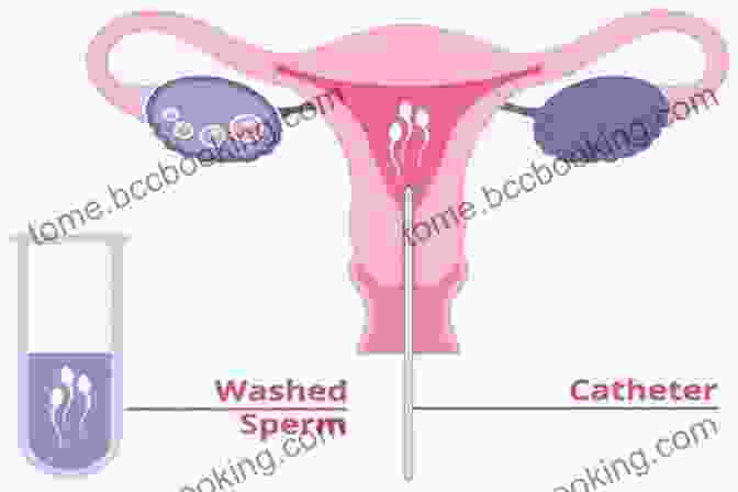 Intrauterine Insemination (IUI) Procedure Infertility: Cure And Assisted Reproduction