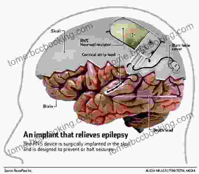 Journey Through Epilepsy And Brain Surgery My Golden Mind: A Journey Through Epilepsy And Brain Surgery